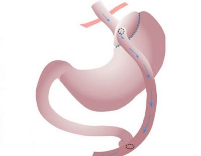 Bypass-gastrique-Tunisie Bypass gastrique Tunisie : Chirurgie bariatrique