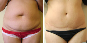 Abdominoplastie et mini-lift abdominal Tunisie : chirurgie réparatrice du ventre