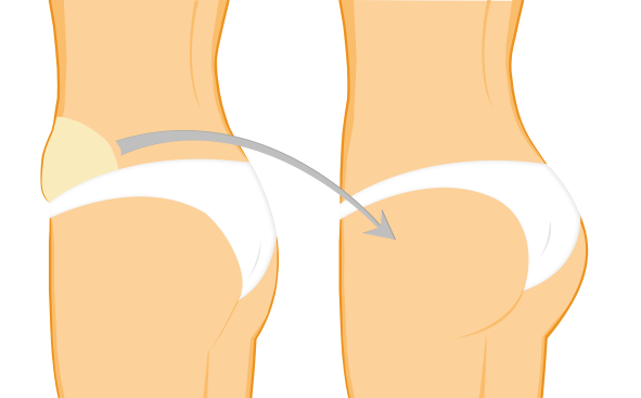 lipofilling fessier