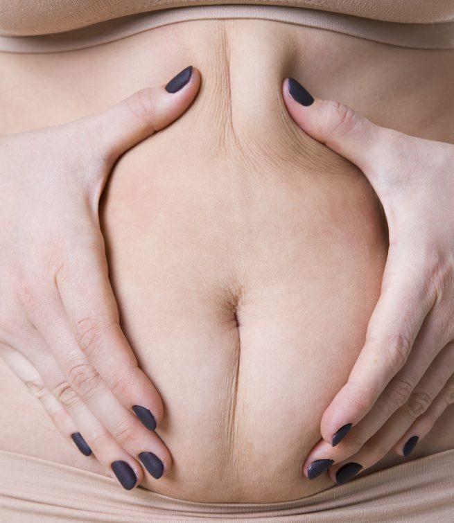 abdominoplastie tunisie