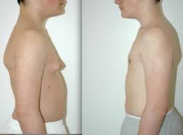 gynecomastie avant apres