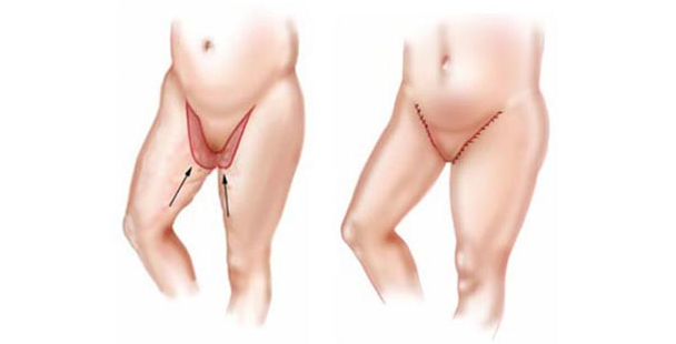 lifting des cuisses tunisie