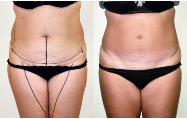 plastie-abdomen tunisie