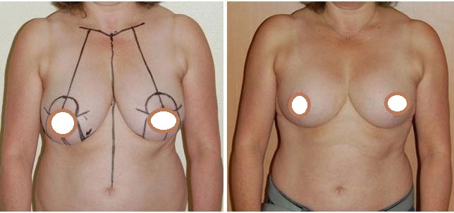 prix diminution des seins Tunisie prix diminution des seins Tunisie