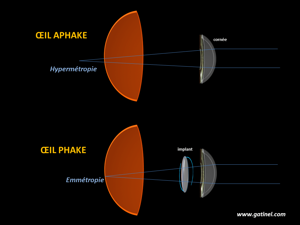 Implants ICL Implants ICL